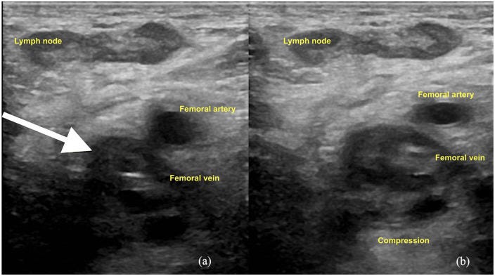 Hernia tempo formacion 3.jpg